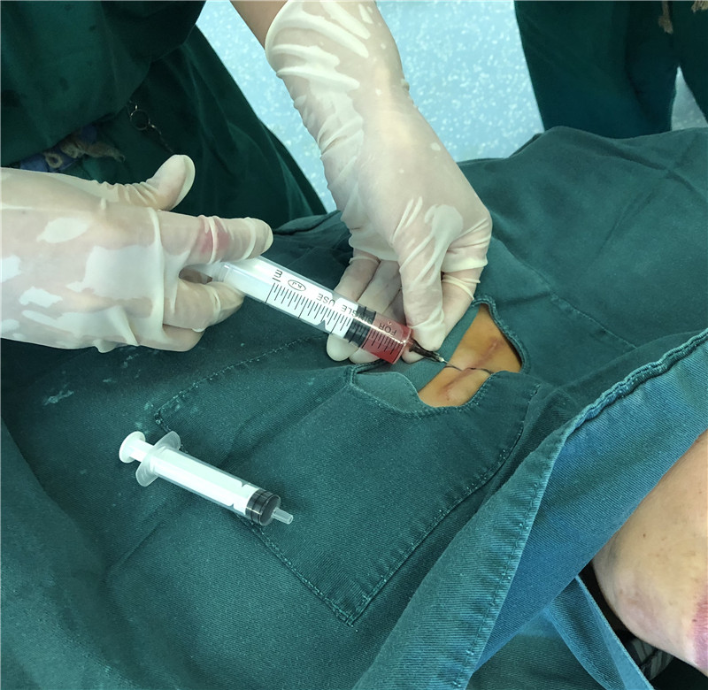 富血小板血浆(PRP)新技术在南京市溧水区人民医院首次开展