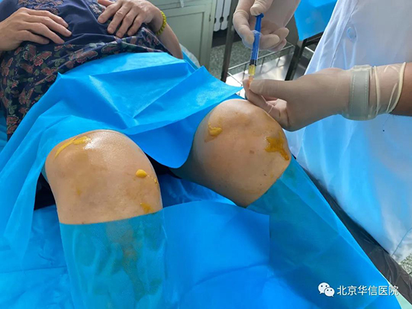 PRP治疗膝关节炎效果好——北京华信医院麻醉科疼痛门诊联合输血科开展新技术