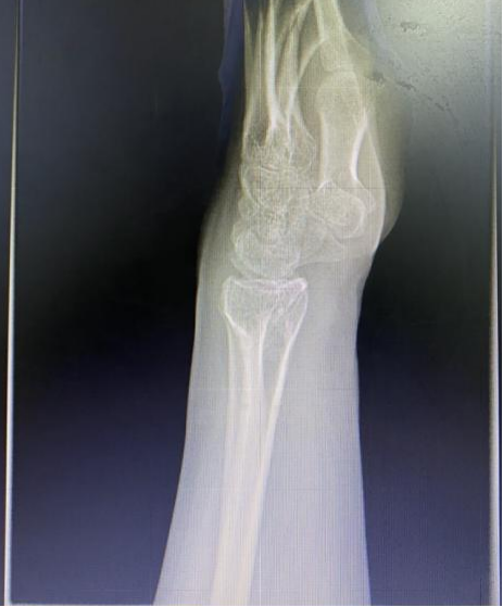 成功开展 “PRP”注射治疗腕关节创伤性关节炎1.png