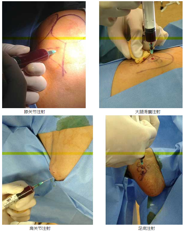 广东省人民医院：运用富血小板血浆技术治疗骨与关节、肌腱疾病