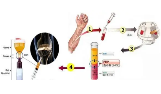 广东医科大学顺德妇女儿童医院：疼痛门诊开展富血小板血浆（PRP）治疗，促进再生修复、关节痛