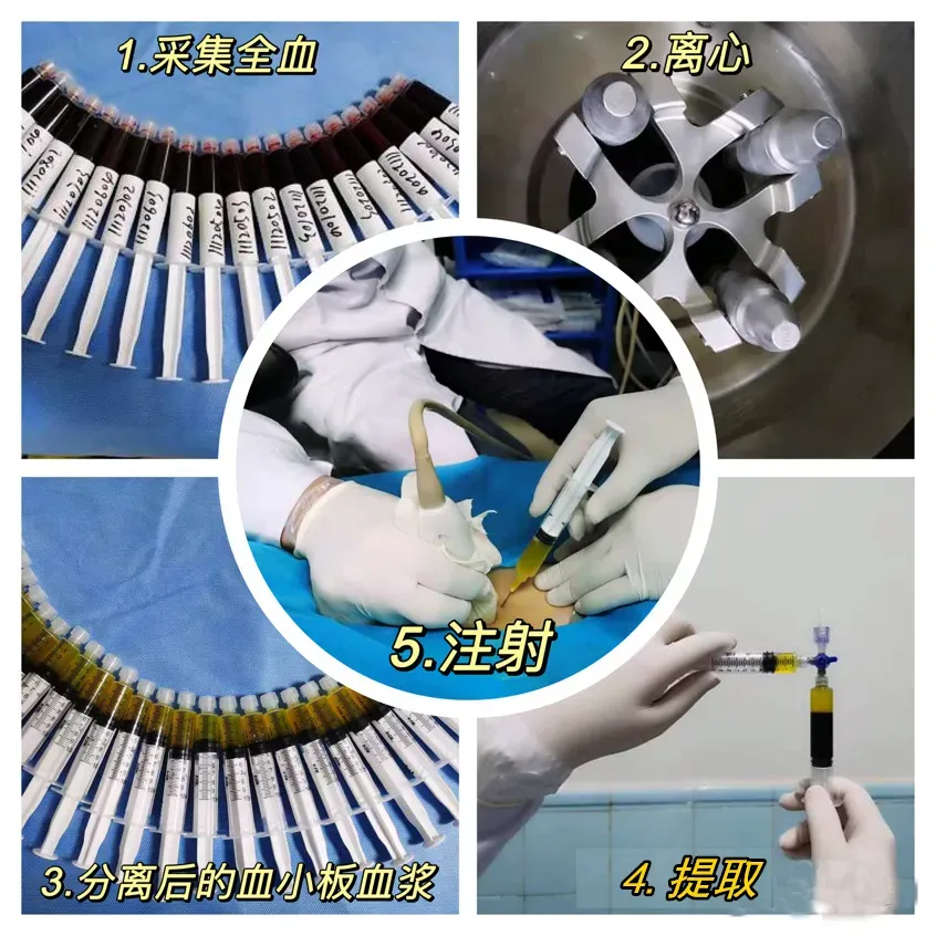 恭城瑶族自治县人民医院：富血小板血浆（PRP）疗法，让你的关节与疼痛说拜拜