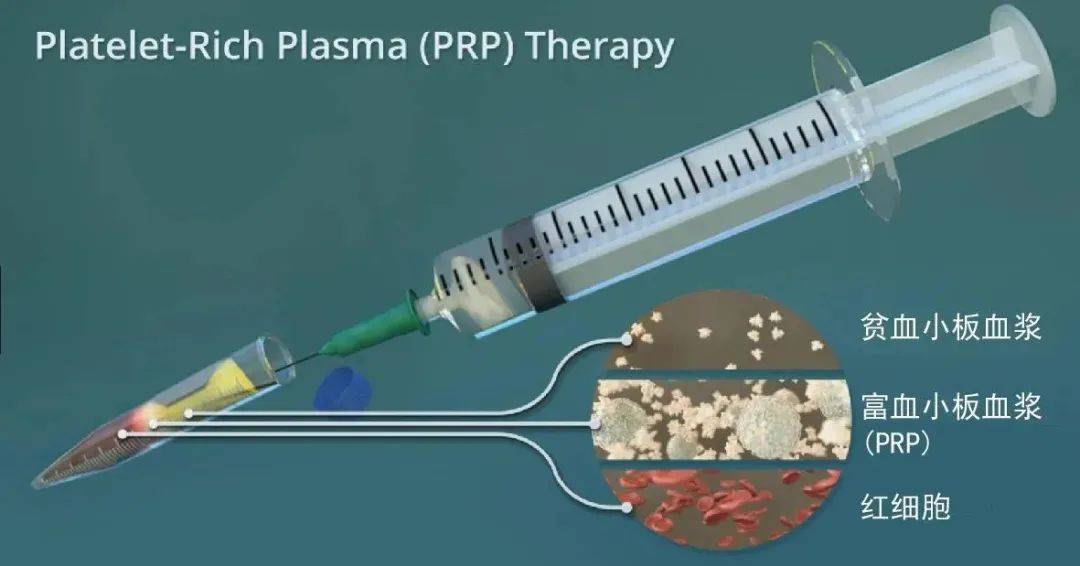 望奎县人民医院骨外科开展新技术——PRP（富血小板血浆治疗）