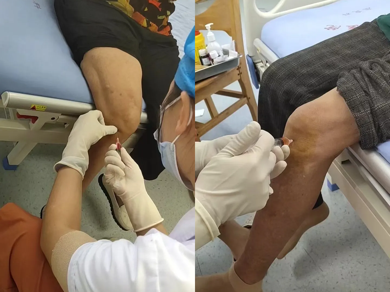 临沧市人民医院康复医学科开展微创PRP注射技术—慢性膝关节疼痛患者的福音