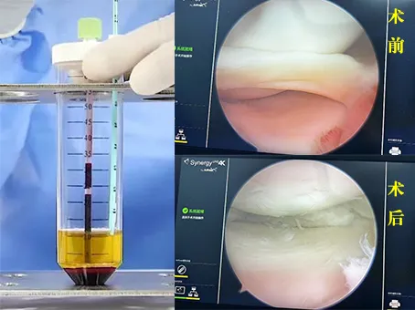 河南省洛阳正骨医院膝关节外四科成功开展PRP技术治疗半月板损伤，开创手术修复新路径