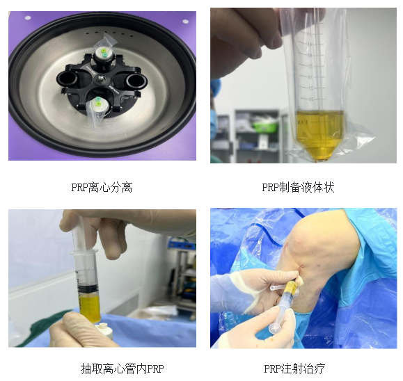 膝骨关节疾病 新“膝”望 ——宿松县人民医院常规开展富血小板血浆（PRP）疗法
