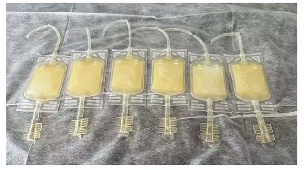 精准赋能临床！北京朝阳医院（常营院区）输血科常营院区成功开展PRP单采治疗