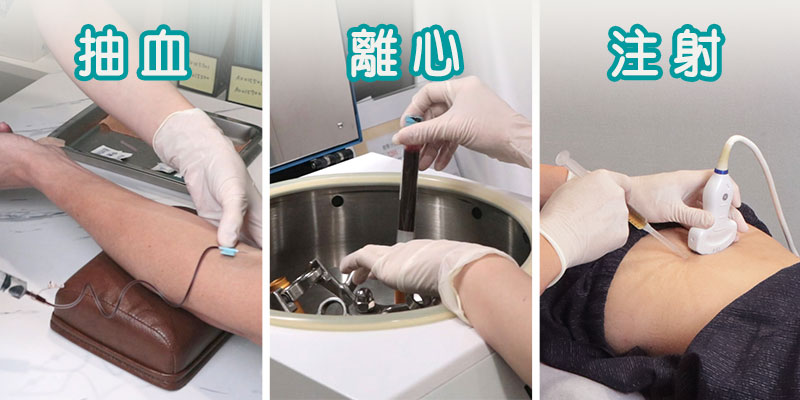 菁英诊所：腰椎间盘突出别担心，PRP注射助你远离手术风险！