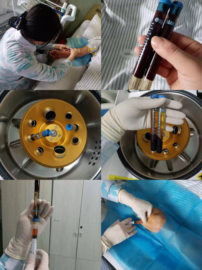 重庆医科大学附属永川医院科普讲堂44｜骨科（关节）开展PRP技术，让受损关节重焕活力